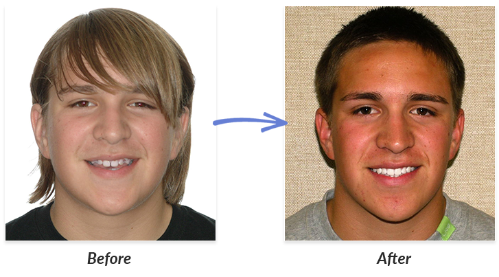 Adult braces before after