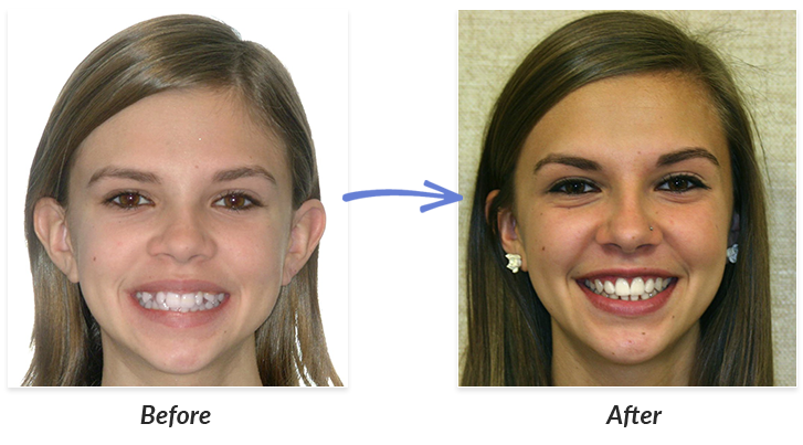 before after braces photos delurgio blom orthodontics