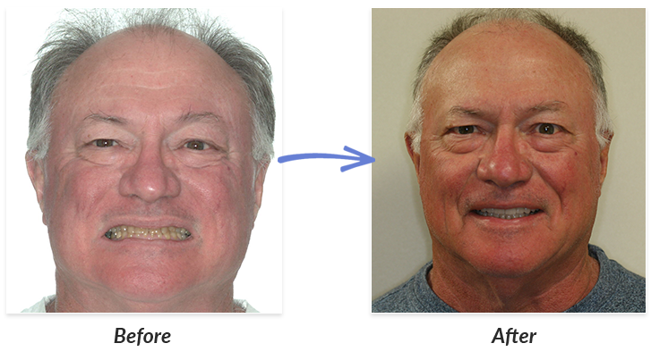 before after braces photos