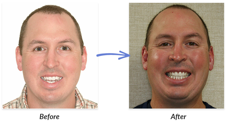 before after braces photos